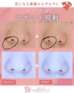 🔴ノーリス・IPL(スポット照射)症例ご紹介 第2弾🔴小鼻周囲の赤みでお悩みの患者さまです。医師施術のスポット照射を3回施術後の経過です。気になっていた鼻横の血管が、徐々に目立ちにくく改善してきました😆照射後はかなり赤みがでますが、ステロイドの塗り薬を1週間使用していただき数日で落ち着きます。症例の方は計6ショット照射しています。1ショット¥1,100(照射範囲でご料金は変動します)⭐️副作用赤み、ひりつき、腫れ⭐️オプションボアラ(ステロイド) 110円小鼻周りの血管・赤みが気になる方、美容相談でお待ちしております✨※別途で初診料、再診料が発生します※効果・副作用には個人差があります✏️ぴか皮ふスタッフ投稿#相模大野ひかる皮ふ科クリニック #ぴか皮ふ #女医 #相模大野 #相模大野駅 #皮膚科 #皮ふ科 #美容皮膚科 #しゅさ #赤ら顔 #IPL #ノーリス #ニキビ跡 #小鼻 #血管