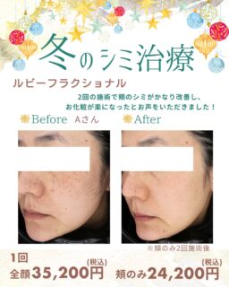 ⛄️今年も夏も暑くて紫外線が強かったですね🥵夏の間にできてしまったシミやそばかす、長年放置していたシミやそばかす、この冬に思い切って治療を始めてみませんか?照射時のお痛みやダウンタイムが発生する施術ではありますが、シミの撃退にはかなり強くインチョーおすすめ!で、患者さまからの満足感も高い施術です✨1回でもしっかり効果がありますが、3〜5回程度回数を重ねるとより効果的です❄️お痛みが心配な方は麻酔クリームの使用がおすすめです🏥3日〜1週間程度のダウンタイムが発生します。スタッフはお昼休憩に照射し、マスクで隠しながら午後のお仕事をしていることも🤫。「マスクで隠せない」「人に見られたくない」という方は、この年末年始前の施術がおすすめです🙊⭐️副作用赤み、ひりつき、炎症後色素沈着、肝斑悪化など⭐️費用頬のみ 24,200円(税込)全顔 35,200円(税込)※2回目以降は2ヶ月以内に再度施術いただくと、20%OFFのリピーター割もございます。⭐️オプション麻酔クリーム 2,200円(税込)アフターケアローション 1,980円(税込)アフターケアローション(プラセンタ入り) 2,640円(税込)⭐️施術料金に別途初診料・再診料がかかります⭐️お客様の承諾を得て写真を掲載しております⭐️効果には個人差がございます✏️ぴか皮ふスタッフ投稿#相模大野ひかる皮ふ科クリニック #ぴか皮ふ #女医 #相模大野 #相模大野駅 #皮膚科 #皮ふ科 #美容皮膚科 #ピコレーザー #ディスカバリーピコプラス #ルビーレーザー #ルビーフラクショナル #piko #シミ #そばかす #毛穴 #ハリツヤ #ルビフラ #シミ治療 #しみ治療