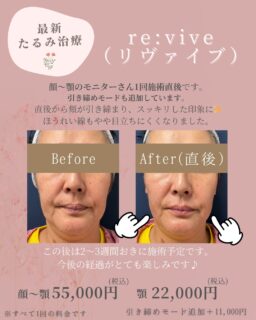 🍒たくさんの方から「新しい機械リヴァイブが気になる！やってみたい！」とお声をいただき、ありがとうございます😊施術いただいた患者さま、多くの方が直後から効果のご実感をいただきスタッフも嬉しいです♪徐々にモニターさんも増えてきたため、ここで症例写真をご紹介いたします。フェイスラインのもたつきや、頬のポニョっと感の撃退にとても良い機械です。モニターさんお二人ともフェイスラインや頬が引き締まり、スッキリした印象になりました👏また、痛みもほとんどなく施術中は「あったか冷たくて、寝ちゃいそうなくらいだった」とのことでした。今後は2〜3週間おきに施術予定です。回数を重ねることでより引き締め効果が期待できますので、今後の経過が楽しみです🤭ボディも含め、まだまだモニターさん募集中です。また、「ちょっとモニターは恥ずかしい」という方も、12月1月平日限定で表示価格から40%OFFキャンペーン中です♡気になる方はぜひ美容相談でご予約ください！⭐️副作用赤み、ほてり、軽度腫れ、痛み⭐️施術料金に別途初診料・再診料がかかります⭐️患者さまの承諾を得て写真を掲載しております⭐️効果には個人差がございます✏️ぴか皮ふスタッフ投稿#小顔治療 #たるみ治療 #脂肪溶解 #リヴァイブ #revive