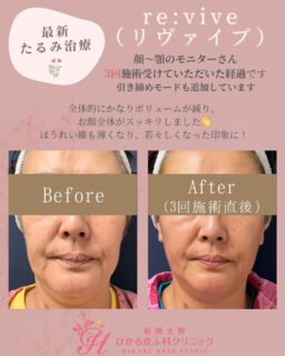 🍒以前投稿させていただきました、モニターさんの経過です🍒先日3回目の施術が終了し、施術前と比べると全体的にかなり引き締まりお顔の印象も変わりました！お友達からも「痩せた？」と聞かれるようになったととても喜んでいただき、スタッフも嬉しいです☺️モニターさんは2〜3週おきに施術を受けていただいております。2〜4週に1回のペースで計3〜5回程度受けていただくと、より高い施術効果が期待できます！まだまだ1月平日限定で表示価格より40%OFFキャンペーン実施中です！気になる方はまずは美容相談でご予約ください🙇‍♀️⭐️副作用赤み、ほてり、軽度腫れ、痛み⭐️施術料金に別途初診料・再診料がかかります⭐️患者さまの承諾を得て写真を掲載しております⭐️効果には個人差がございます✏️ぴか皮ふスタッフ投稿#小顔治療 #たるみ治療 #脂肪溶解 #リヴァイブ #revive