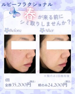 ☘️春は卒業式・入学式などとお写真を撮る機会が増えますね！素敵な思い出を残す準備として、今からシミ取りしませんか？「コンシーラーがいらなくなってメイクが楽になった！」「顔色が明るくなった！」とシミが取れるとお顔だけではなく、雰囲気も明るくなった患者さまも💛「1カ所ポイントのシミが気になる」という方は、その部分のみをお当てするスポット照射もございます。お悩みに最適な施術をインチョーがご案内させていただきますので、気になる方は美容相談でご予約ください🙇‍♀️⭐️副作用赤み、ひりつき、炎症後色素沈着、肝斑悪化など⭐️費用頬のみ　24,200円(税込)全顔　35,200円(税込)※2回目以降は2ヶ月以内に再度施術いただくと、20%OFFのリピーター割もございます。⭐️オプション麻酔クリーム　2,200円(税込)アフターケアローション　1,980円(税込)アフターケアローション（プラセンタ入り）　2,640円(税込)トラネキサム酸250mg 90錠　1,650円(税込)シナール 90錠　1,980円(税込)⭐️施術料金に別途初診料・再診料がかかります⭐️患者様の承諾を得て写真を掲載しております⭐️効果には個人差がございます✏️ぴか皮ふスタッフ投稿#ルビーレーザー #ルビーフラクショナル #シミ #そばかす #ルビフラ