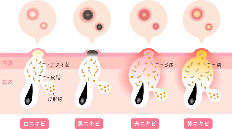 にきびの種類