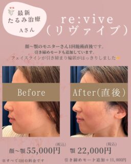 🍒1月平日も、まだまだリヴァイブ40%OFFキャンペーン中です🍒前回の投稿からさらにモニターさんのご協力をいただきましたので、ご紹介させていただきます！Aさんはマリオネットラインのたるみがお悩みでご来院されました。顔〜顎1回施術直後です。(引き締めモードも追加しています。)直後から頬のボリュームが減り、お口周りが引き締まりました。フェイスラインもシャープになりました👏Bさんは腹部1回施術直後です。(引き締めモードも追加しています。)腹部などのボディは、気になる部分の大きさによってお値段が変わります。今回は気になる部分を一緒に確認し、白いマーキングの内側を行いました。当てた箇所が引き締まったことで、周囲もボリュームが減り全体的にすっきりした印象に👏モニターさんは2〜3週おきに施術を受けていただいております。2〜4週に1回のペースで計3〜5回程度受けていただくと、より高い施術効果が期待できます！リヴァイブはお顔はもちろん、気になるお腹や二の腕などの引き締めにもおすすめの機械です💡クリスマスや年末年始の食生活でゆるんでしまったお顔やお身体、夏に向けて今から引き締めていきませんか？⭐️副作用赤み、ほてり、軽度腫れ、痛み⭐️施術料金に別途初診料・再診料がかかります⭐️患者さまの承諾を得て写真を掲載しております⭐️効果には個人差がございます✏️ぴか皮ふスタッフ投稿#小顔治療 #たるみ治療 #脂肪溶解 #リヴァイブ #revive